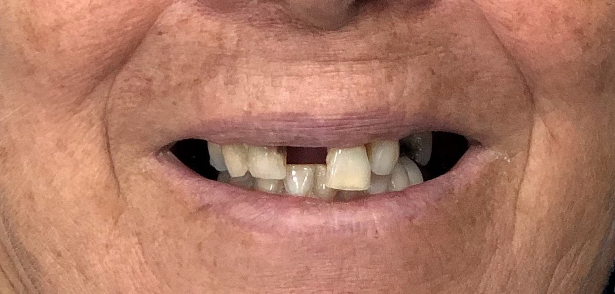 Caso 1 — Implante Dentário Antes