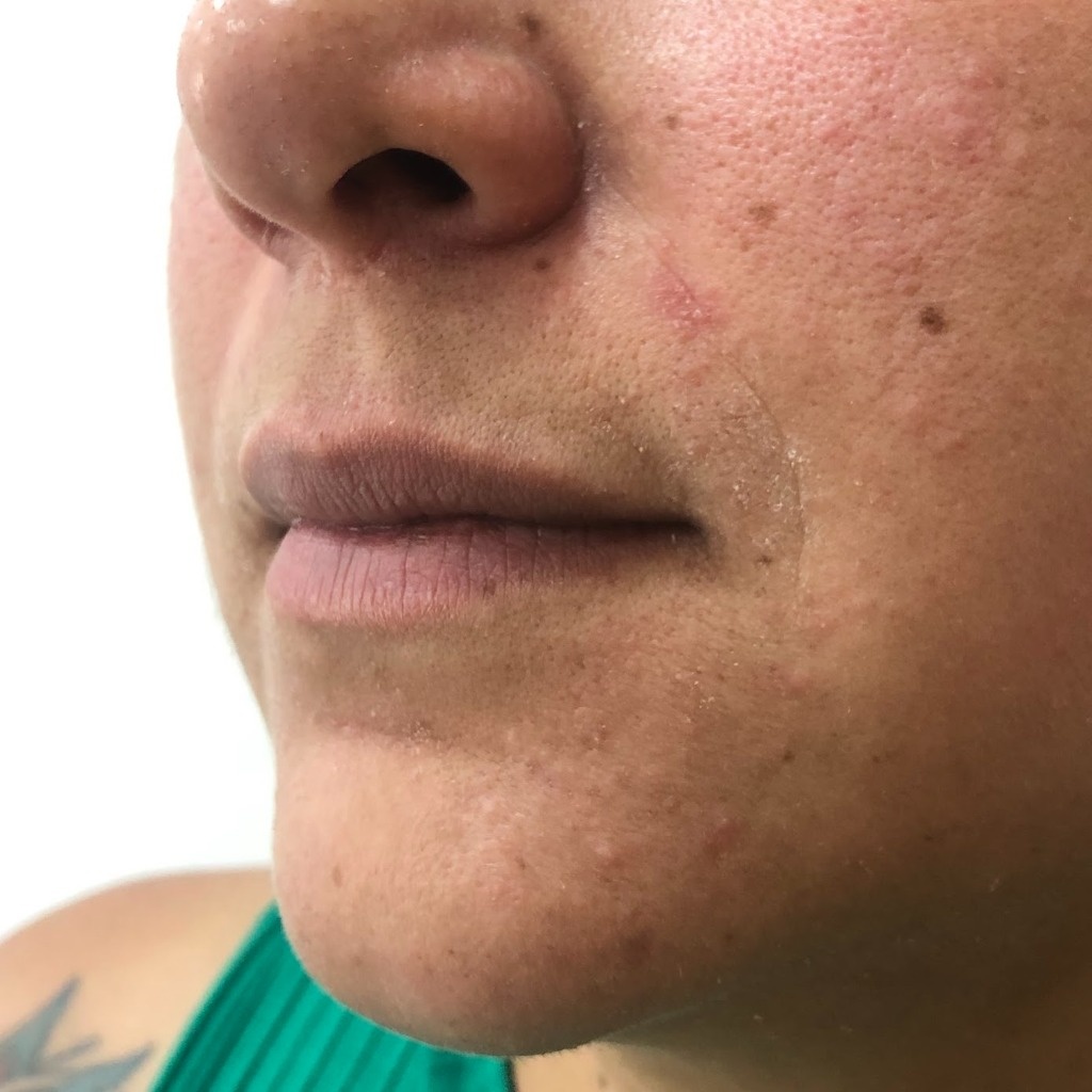 Resultado de preenchimento labial — Foto Antes