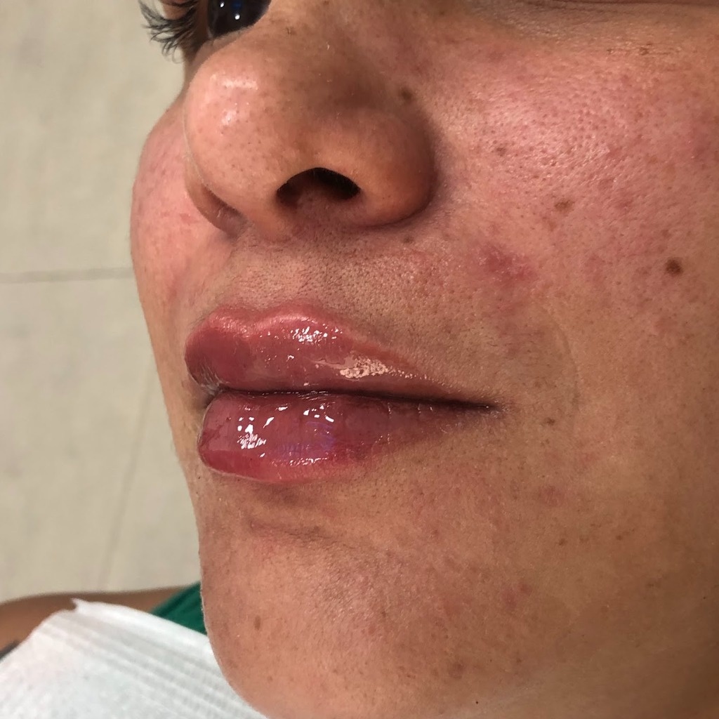 Resultado de preenchimento labial — Foto Depois